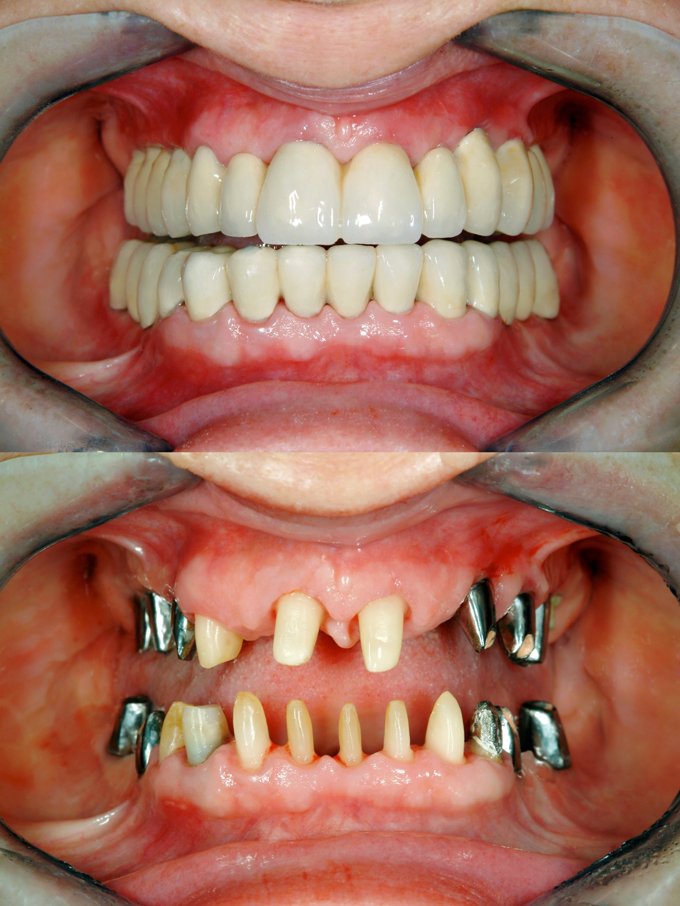 Dental Implant Dentists in Lancashire