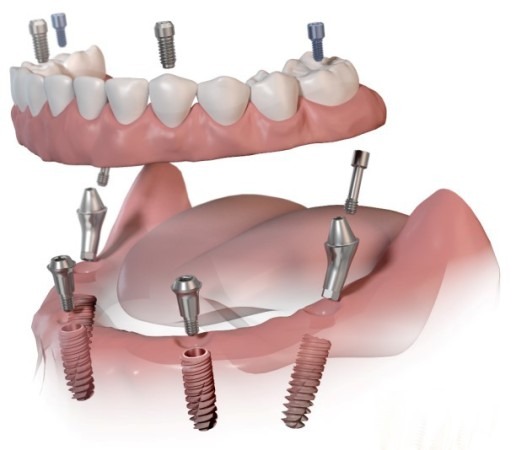 Individualised implant dentures