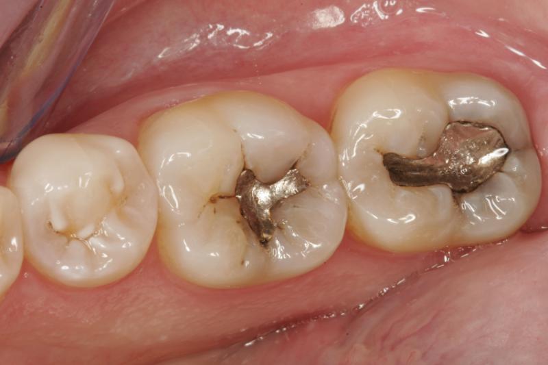 Silver Amalgam filling image