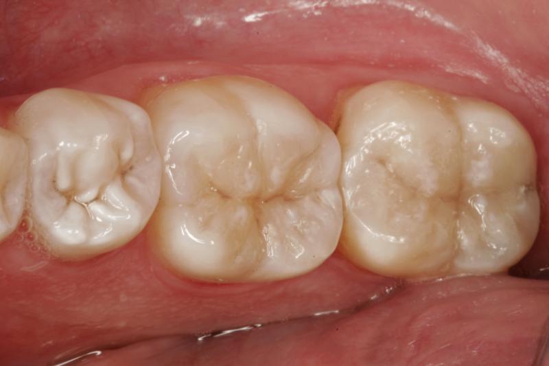 White Composite Filling Image