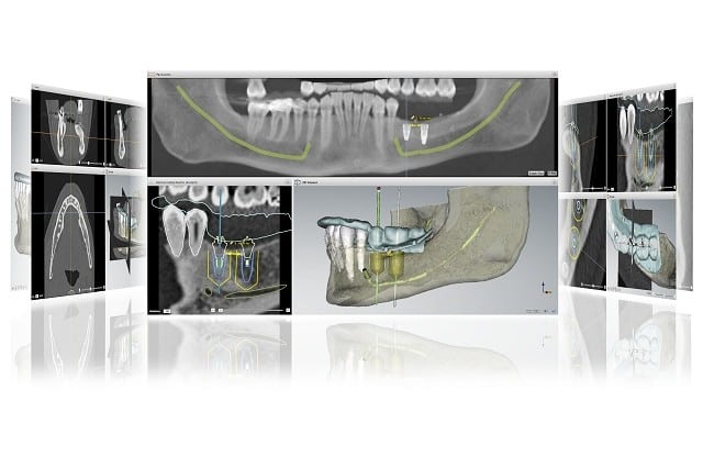 Recommended Implant Dentist