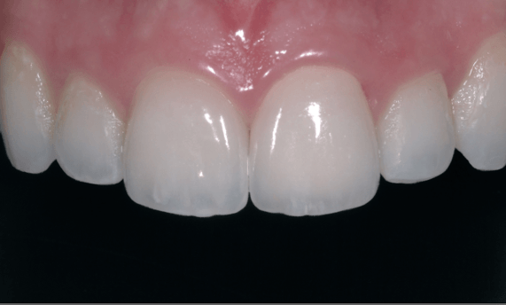 Tooth Coloured filling- front teeth after photo