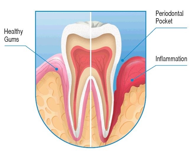 gum disease symptoms