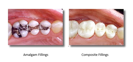 White Fillings replacing Mercury Fillings