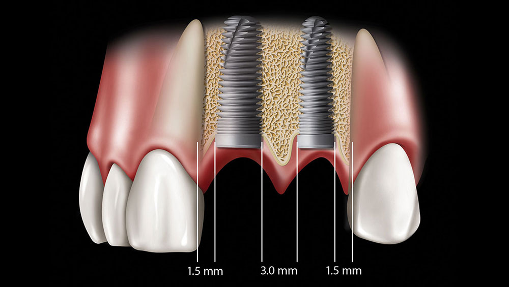 Missing Teeth Replacements