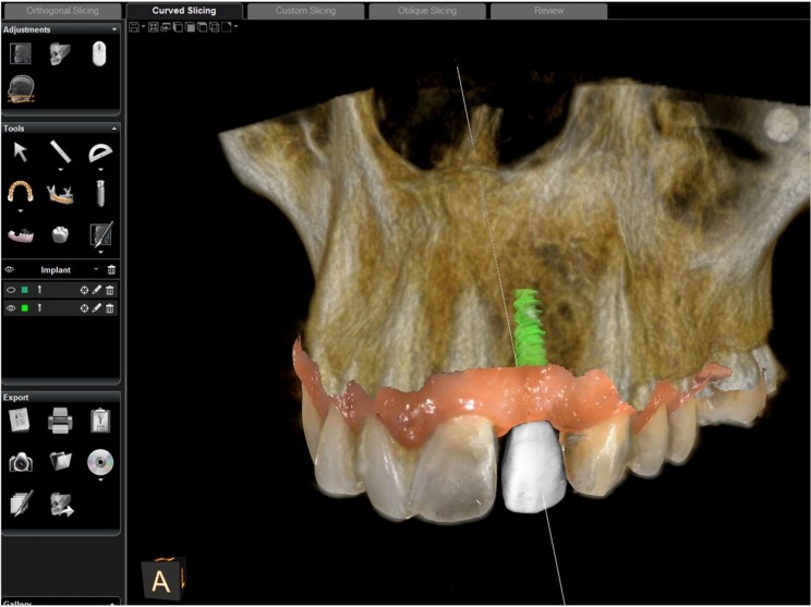 Dental Implant Specialist UK