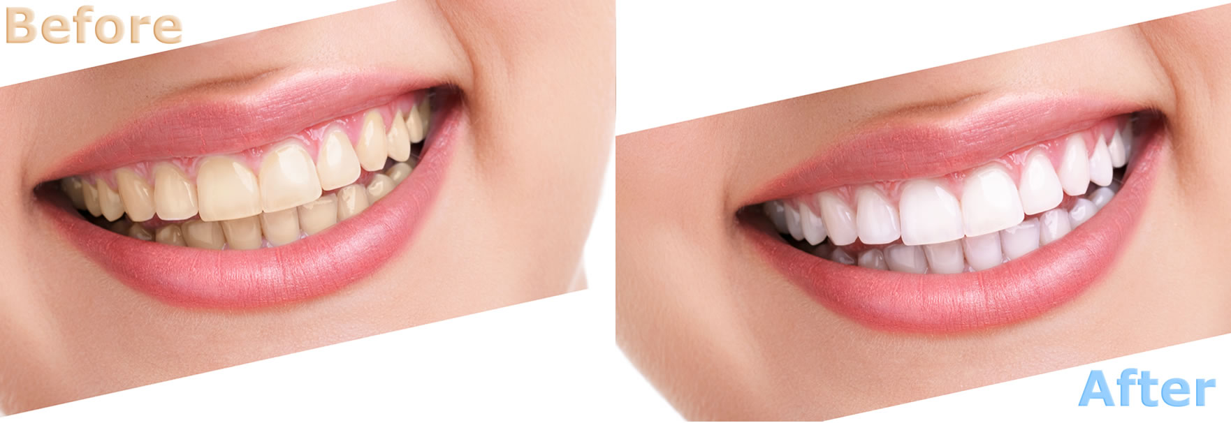 Cosmetic Dentistry Makeover