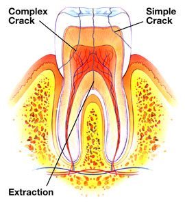 fractured tooth treatment