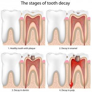 Dental Fillings