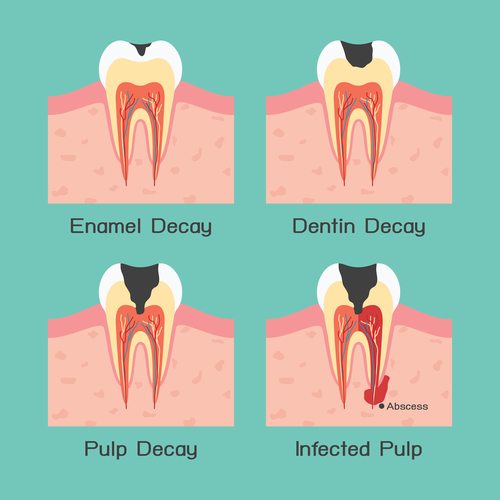 Tooth Abscess