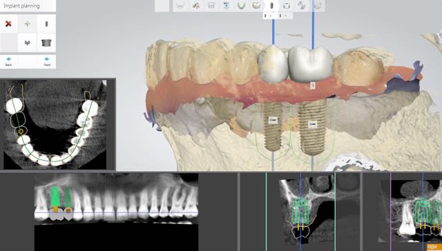 Low - Radiation Dental X rays