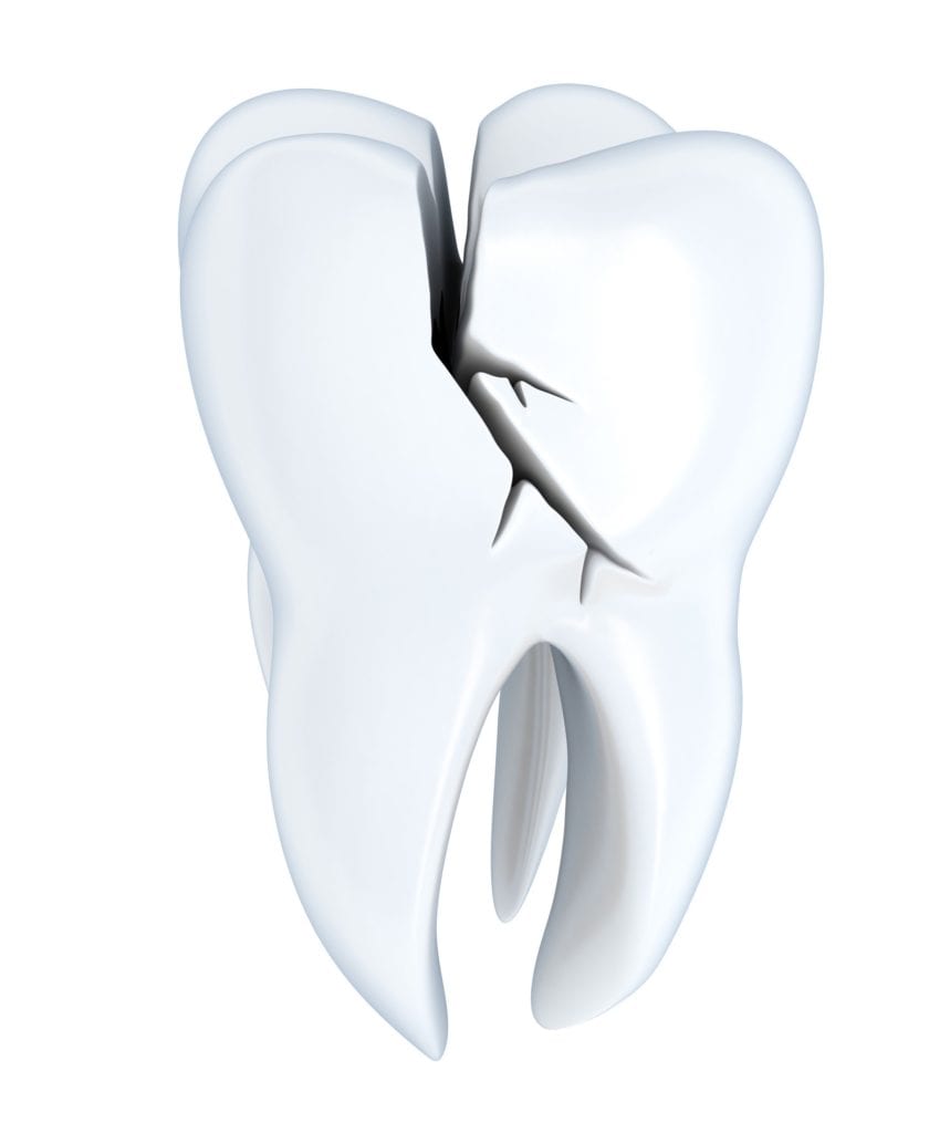 Cracked Tooth Causes And Treatments Cosmetic Dentists In Lancashire