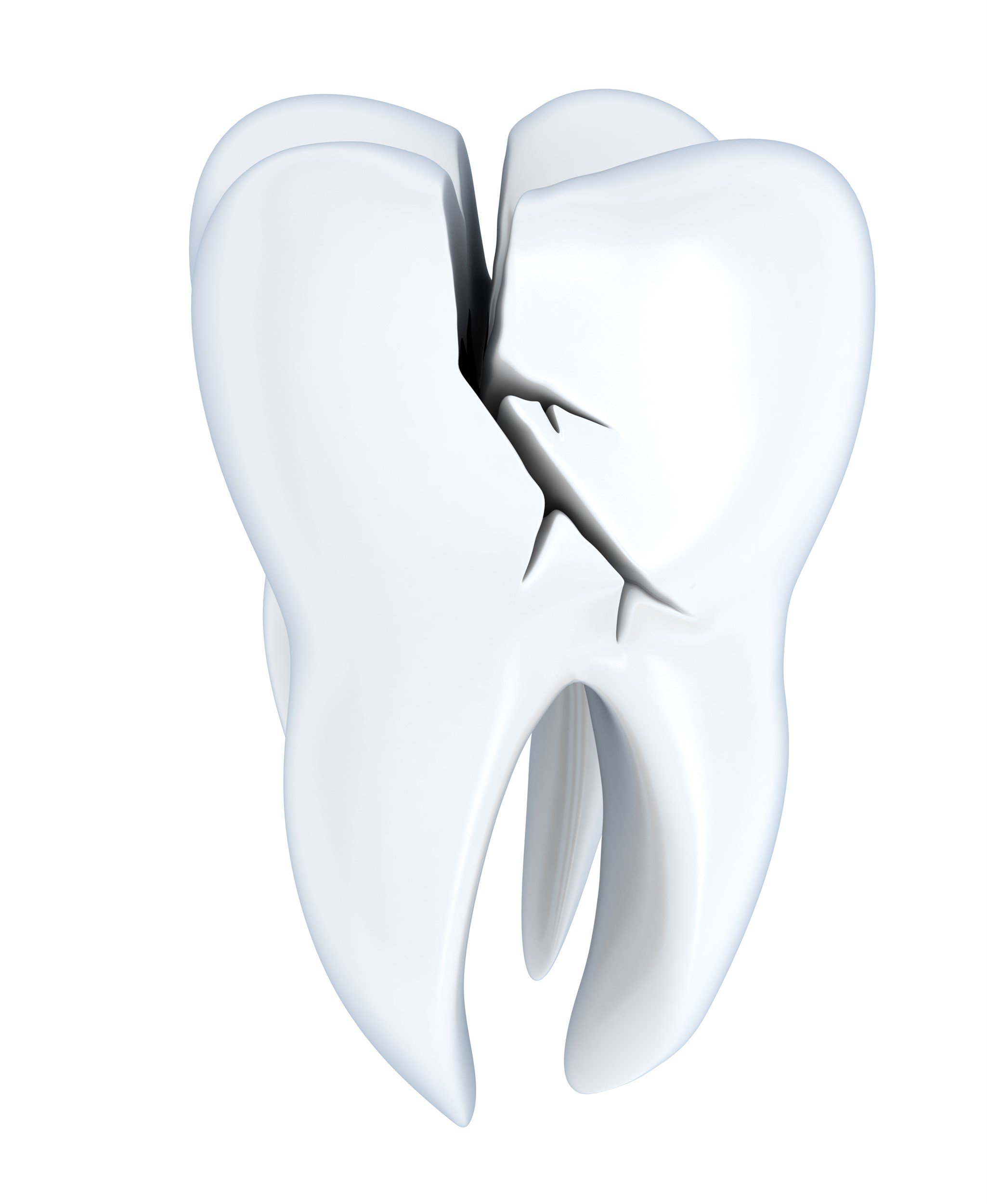 cracked tooth treatment