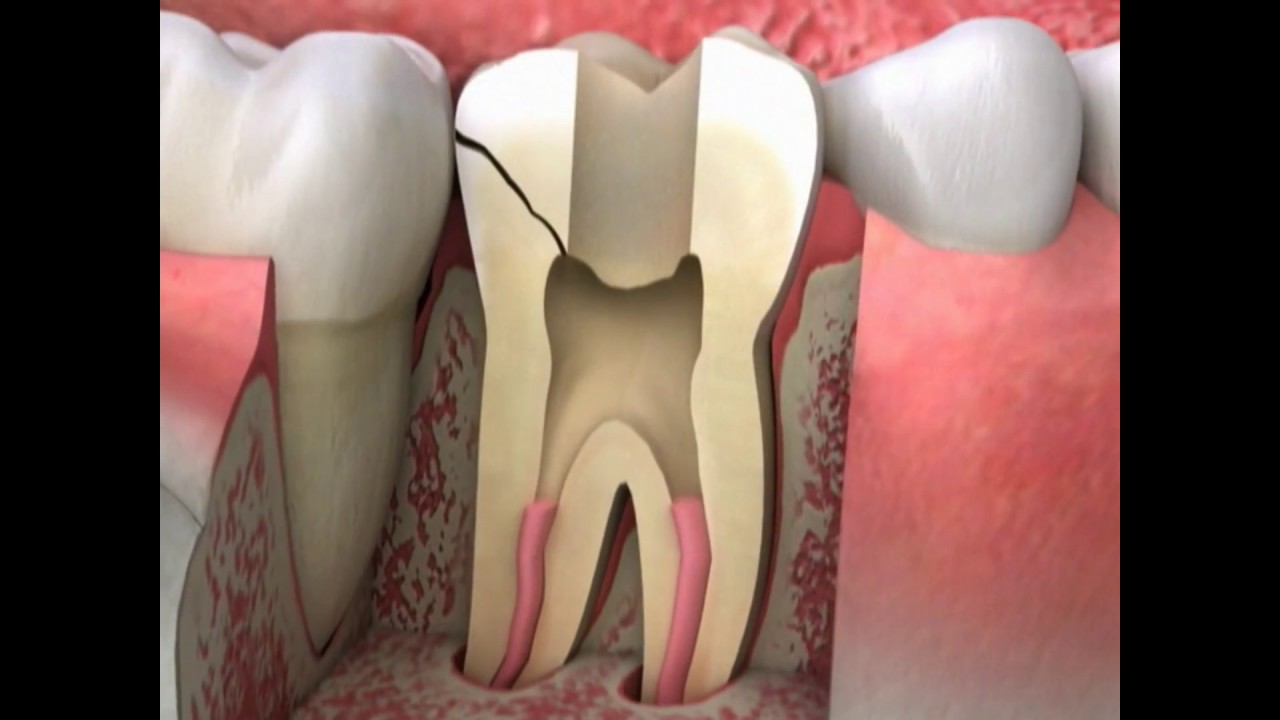 cracked tooth diagnosis