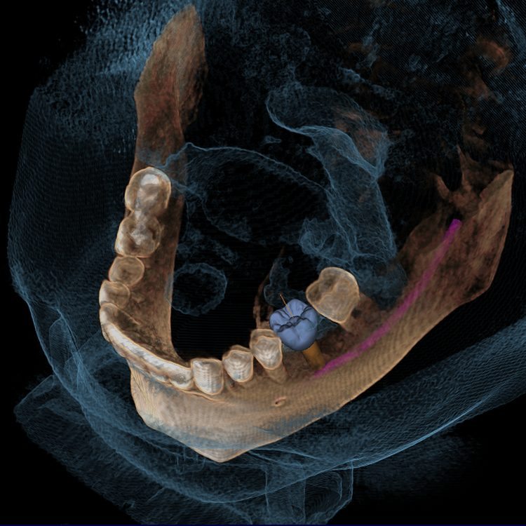 Tooth Crowns