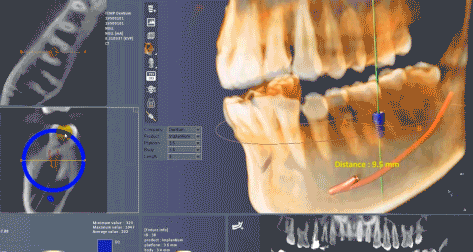 3D digital Dental X-rays