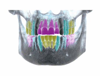 Same day teeth - dental implants