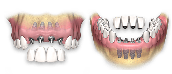 Dental Implants Process