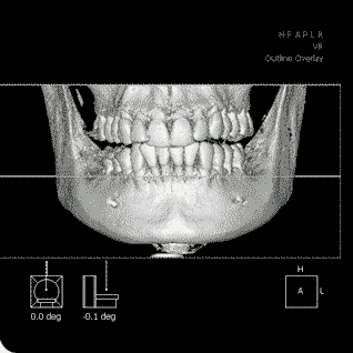 Dental Implants Surgery Guide