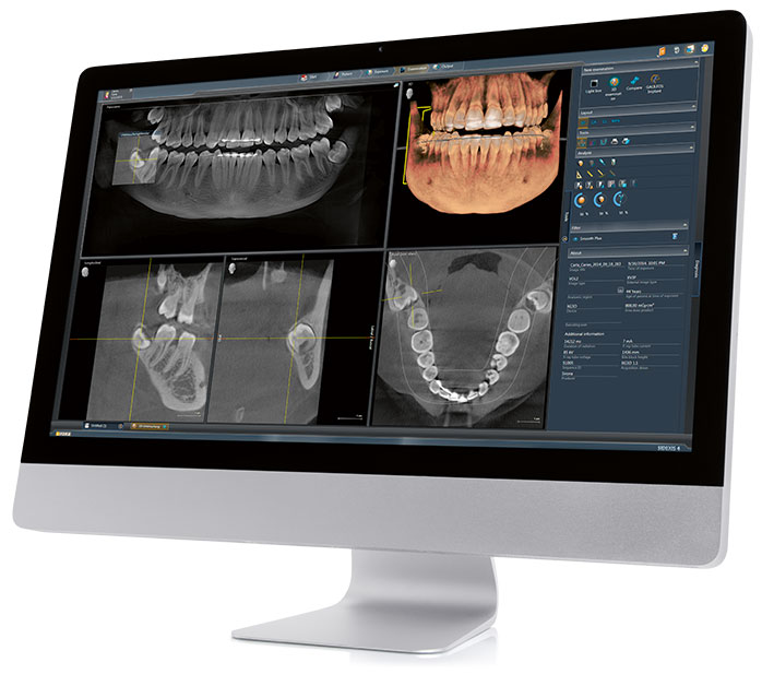 Digital Dental X-rays