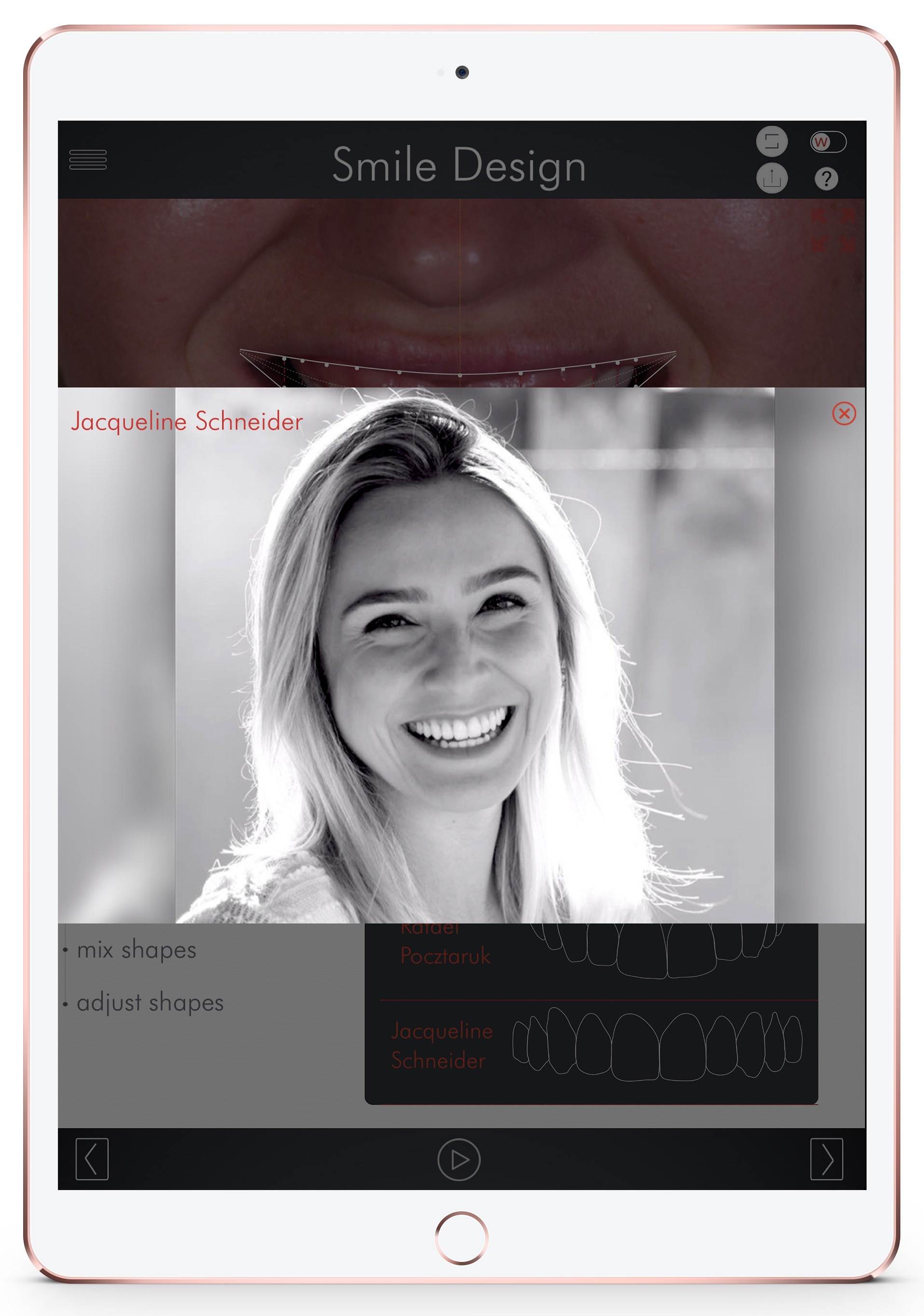 Types of Dental Crowns