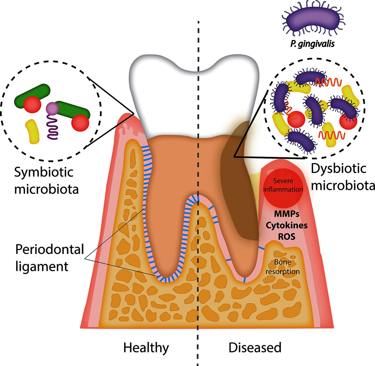 Halitosis and bad breath