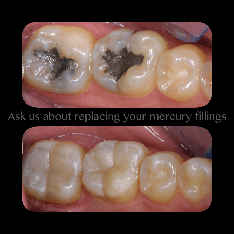Dental Inlays Onlays before and after photos