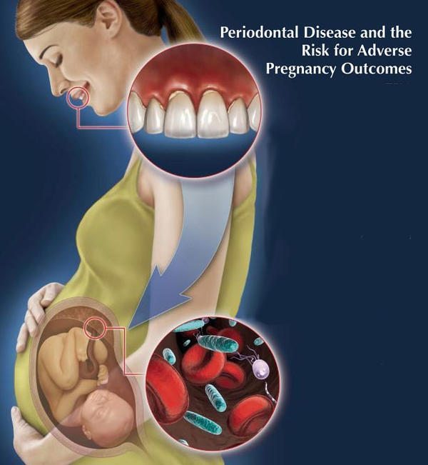 pregnancy causing gum disease