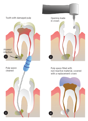 Treating Tooth Abscess