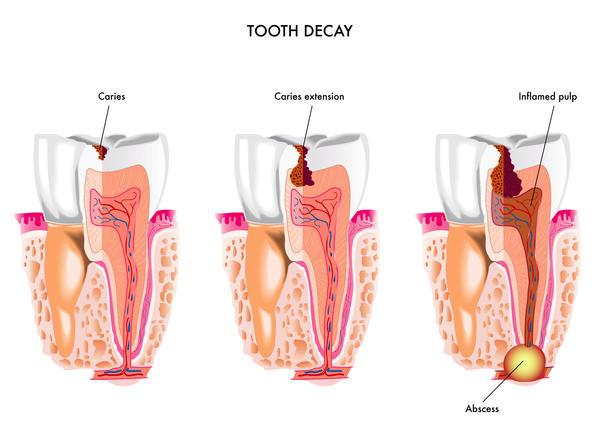 Abscessed Tooth Symptoms