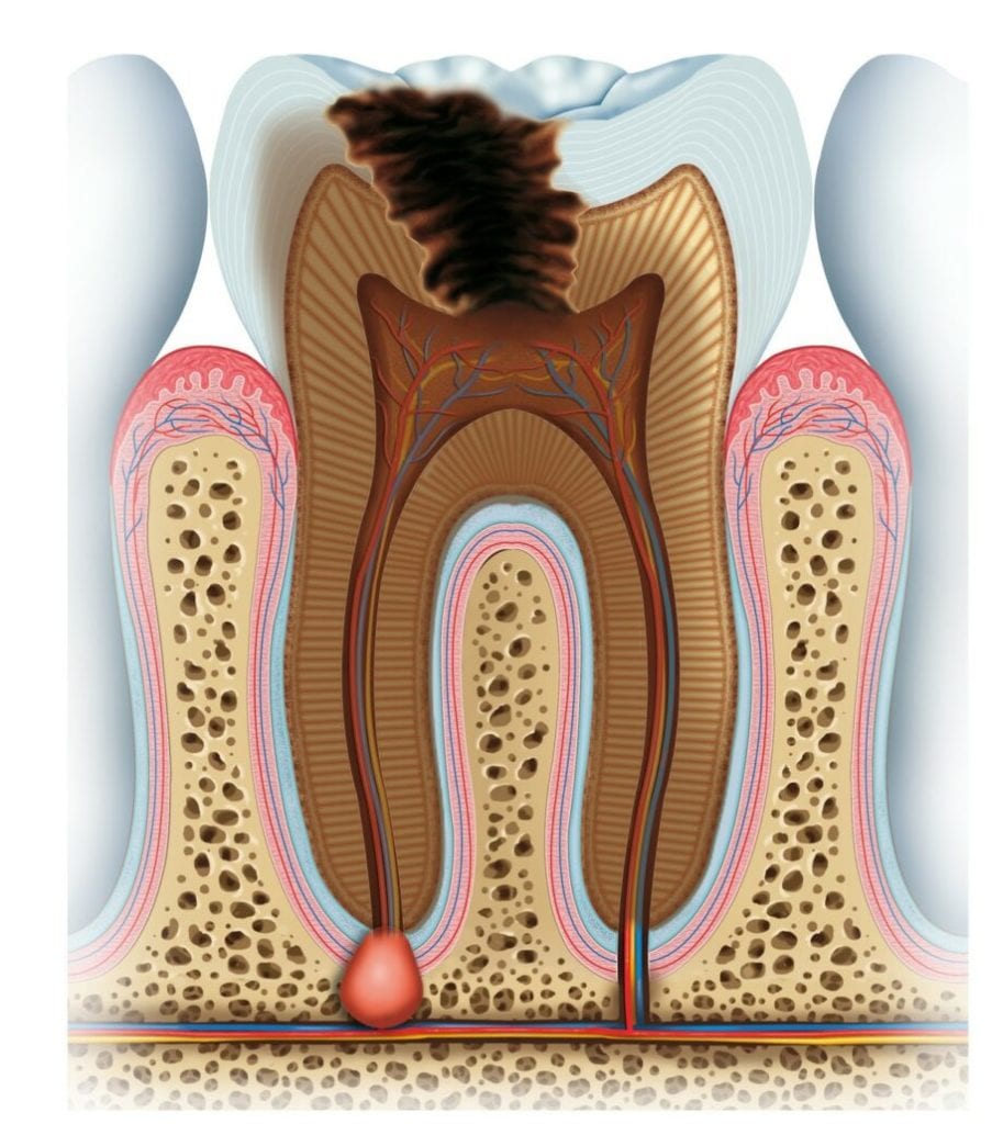 Abscessed Tooth Types, Symptoms, Causes, Treatment Private Dentists