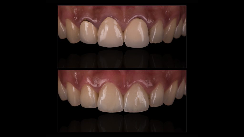 Dental Crowns before and after images Tooth crowns before and after photos