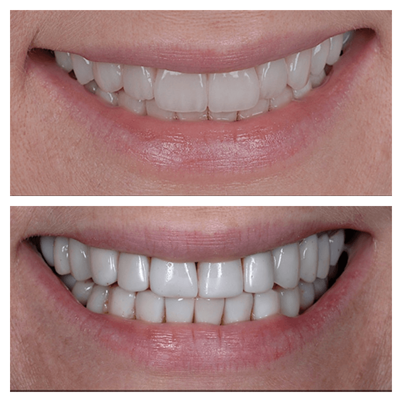 full mouth rehabilitation before and after