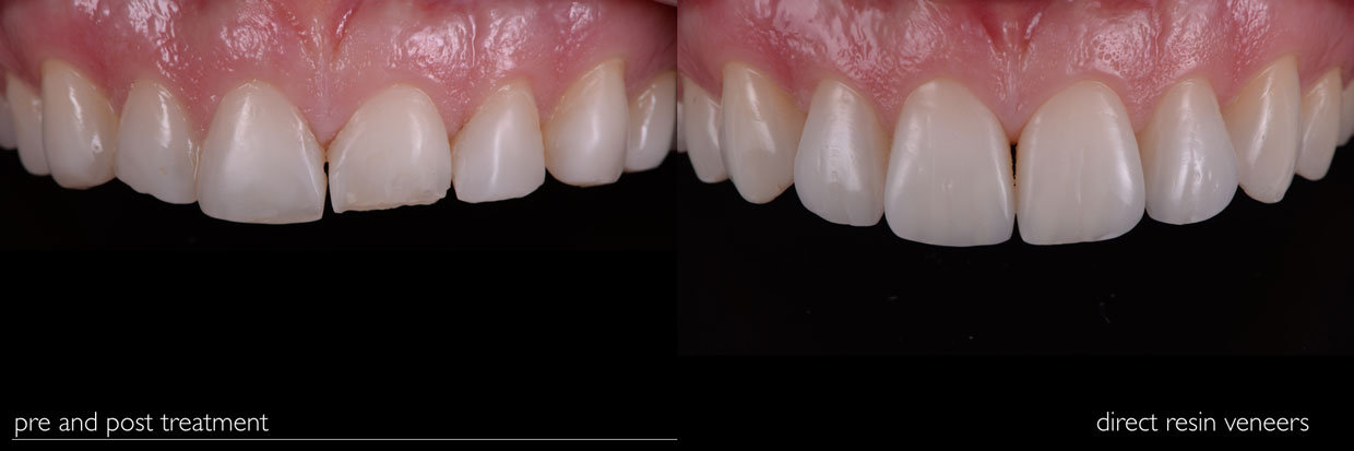 Smile Gallery - Before and After Dental Photos - Smile Makeovers .