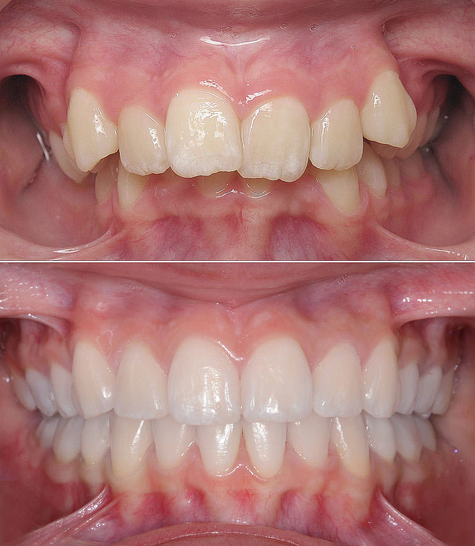 Full smile makeover before and after photos