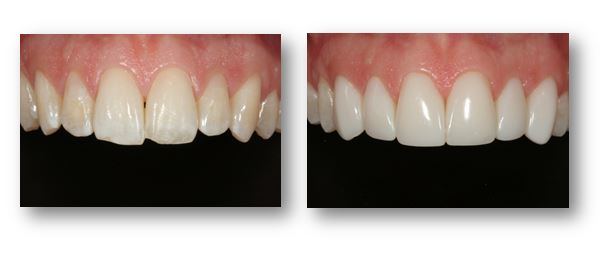 Before & After Dental Photos