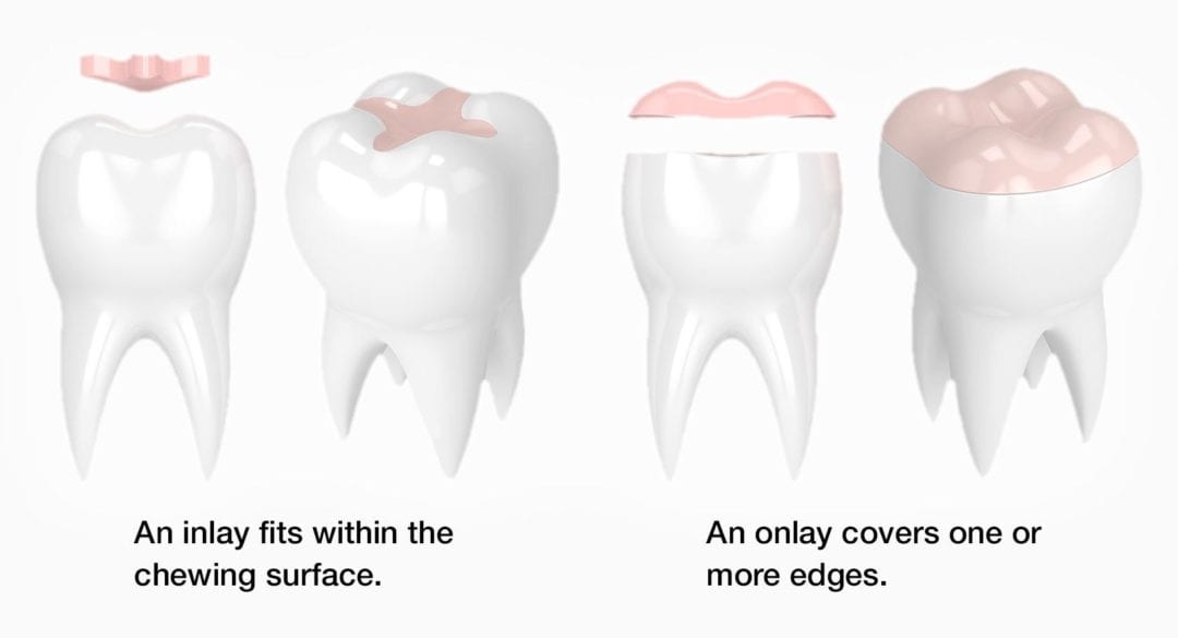 Dental Inlays and Onlays | Preston Lancashire | Cosmetic Dental Clinic