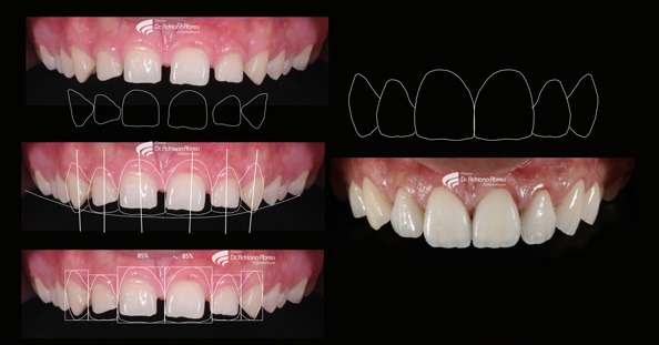 Gappy Smile treatment Before and After images