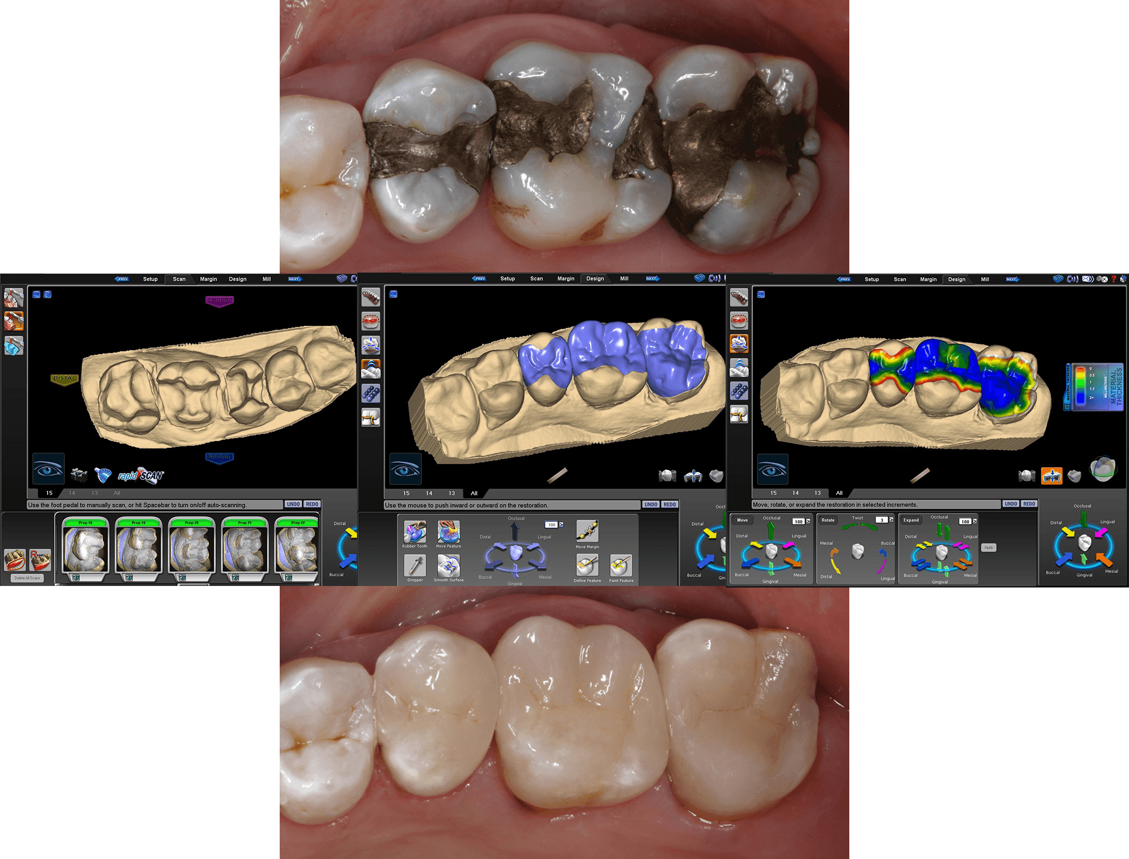 Mercury free restorations before and after gallery