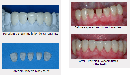 Images for smile gallery before and after