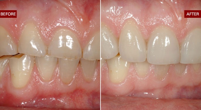 Cosmetic Dentistry makeover Before and after photos